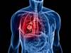 Alectinib Approved by FDA for Non-Small Cell Lung Cancer Alectinib Approved by FDA for Non-Small Cell Lung Cancer