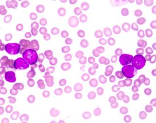 Researchers have identified 55 genetic driver events involved in the development and progression of CLL. Researchers have identified 55 genetic driver events involved in the development and progression of CLL.