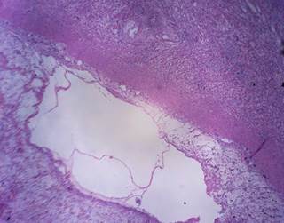 Researchers are evaluating the safety and efficacy of FOLFOX plus nab-paclitaxel as a first-line therapy for patients with advanced gastric cancer or adenocarcinoma of the gastroesophageal junction. Researchers are evaluating the safety and efficacy of FOLFOX plus nab-paclitaxel as a first-line therapy for patients with advanced gastric cancer or adenocarcinoma of the gastroesophageal junction.
