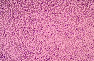 A single course of alemtuzumab in T-cell large granular lymphocytic leukemia (T-LGL) can induce a hematological response. A single course of alemtuzumab in T-cell large granular lymphocytic leukemia (T-LGL) can induce a hematological response.