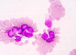 Most patients with progressive chronic lymphocytic leukemia receiving ibrutinib therapy harbor BTK and/or PLCG2 mutations. Most patients with progressive chronic lymphocytic leukemia receiving ibrutinib therapy harbor BTK and/or PLCG2 mutations.