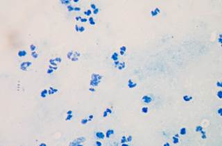 Tyrosine kinase inhibitors have revolutionized chronic myeloid leukemia treatment and changed the role of transplantation in CML management. Tyrosine kinase inhibitors have revolutionized chronic myeloid leukemia treatment and changed the role of transplantation in CML management.