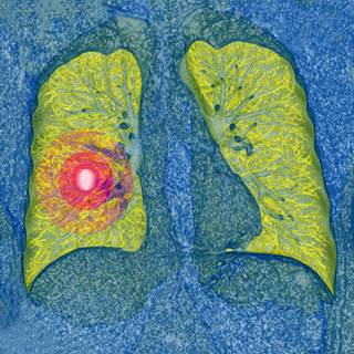 Dacomitinib is an active agent with comparable efficacy to erlotinib in patients with non-small cell lung cancer. Dacomitinib is an active agent with comparable efficacy to erlotinib in patients with non-small cell lung cancer.