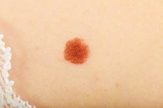 Nonwhite organ transplant recipients are at risk for developing non-melanoma skin cancer following transplantation. Nonwhite organ transplant recipients are at risk for developing non-melanoma skin cancer following transplantation.