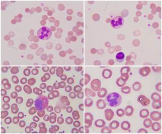Treatment with ibrutinib may be associated with favorable progression-free and overall survival as well as high overall response rate. Treatment with ibrutinib may be associated with favorable progression-free and overall survival as well as high overall response rate.