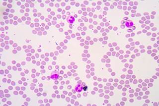 The FDA has accepted a New Drug Application (NDA) and granted Priority Review for venetoclax for treatment of chronic lymphocytic leukemia. The FDA has accepted a New Drug Application (NDA) and granted Priority Review for venetoclax for treatment of chronic lymphocytic leukemia.