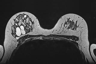 This fact sheet helps patients learn about the cause, symptoms, treatment, and prognosis for Paget disease of the breast. This fact sheet helps patients learn about the cause, symptoms, treatment, and prognosis for Paget disease of the breast.