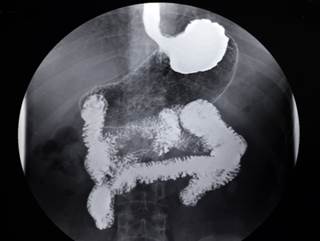 Pembrolizumab monotherapy showed clinical efficacy in patients with advanced gastric cancer. Pembrolizumab monotherapy showed clinical efficacy in patients with advanced gastric cancer.