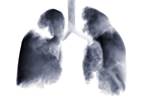 Long-Term Gefitinib Can Be Effective in Patients With NSCLC Long-Term Gefitinib Can Be Effective in Patients With NSCLC