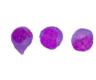 Bosutinib has shown promise in patients with Philadelphia-positive chronic phase chronic myeloid leukemia. Bosutinib has shown promise in patients with Philadelphia-positive chronic phase chronic myeloid leukemia.