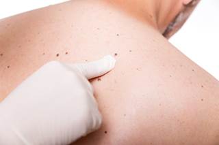 Dermoscopic features can help diagnose SK-like melanoma, though histopathologic analysis may still be necessary. Dermoscopic features can help diagnose SK-like melanoma, though histopathologic analysis may still be necessary.