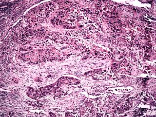 Cisplatin, etoposide, and irinotecan may be clinically beneficial as a second-line chemotherapy for selected patients with small cell lung cancer. Cisplatin, etoposide, and irinotecan may be clinically beneficial as a second-line chemotherapy for selected patients with small cell lung cancer.