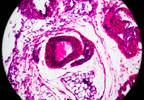 VcR-CVAD Regimen Induces Durable Remissions in Mantle Cell Lymphoma VcR-CVAD Regimen Induces Durable Remissions in Mantle Cell Lymphoma