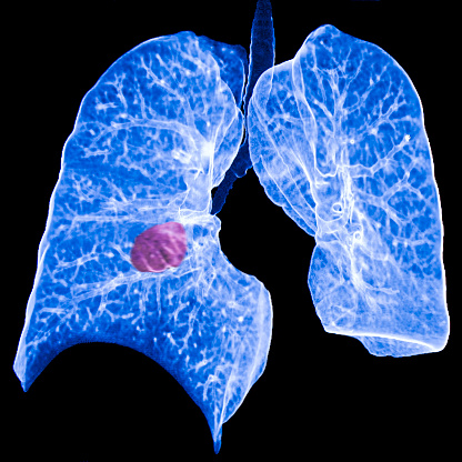 Lobectomy vs Stereotactic Body Radiation Therapy in Non-Small Cell Lung