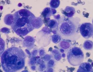 Investigators randomly assigned 1501 patients with completely resected stage IB to IIIA NSCLC to receive chemotherapy alone or chemotherapy plus bevacizumab. Investigators randomly assigned 1501 patients with completely resected stage IB to IIIA NSCLC to receive chemotherapy alone or chemotherapy plus bevacizumab.