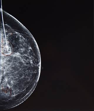 Clinicians ought to counsel patients that IORT can increase one’s risk of ipsilateral breast tumor recurrence. Clinicians ought to counsel patients that IORT can increase one’s risk of ipsilateral breast tumor recurrence.