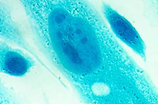 Researchers obtained biopsies from 49 men with high-risk prostate cancer to determine genomic and T cell intratumoral heterogeneity. Researchers obtained biopsies from 49 men with high-risk prostate cancer to determine genomic and T cell intratumoral heterogeneity.