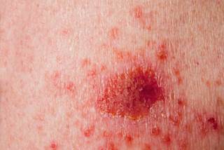Two intermittent vismodegib dosing regimens for long-term treatment demonstrated good activity among patients with multiple basal cell carcinomas. Two intermittent vismodegib dosing regimens for long-term treatment demonstrated good activity among patients with multiple basal cell carcinomas.