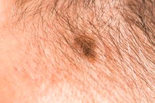 Talimogene laherparepvec plus ipilimumab improves the overall response rate over ipilimumab alone among patients with unresected, advanced melanoma. Talimogene laherparepvec plus ipilimumab improves the overall response rate over ipilimumab alone among patients with unresected, advanced melanoma.
