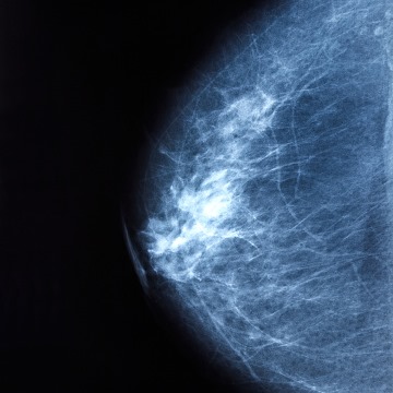 Managing Menopausal Symptoms in Breast Cancer Survivors