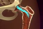 Duloxetine Improves Aromatase Inhibitor-related Joint Pain Duloxetine Improves Aromatase Inhibitor-related Joint Pain