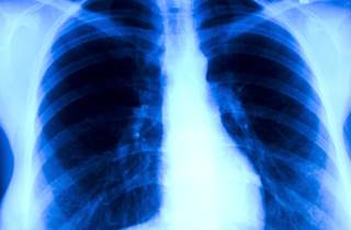Significant improvements were seen with the addition of atezolizumab to CnP in stage IV non-squamous non-small cell lung cancer, regardless of patient PD-L1 status. Significant improvements were seen with the addition of atezolizumab to CnP in stage IV non-squamous non-small cell lung cancer, regardless of patient PD-L1 status.
