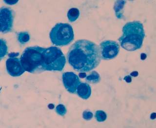 Dako/Agilent 28-8, Dako/Agilent 22c3, and Leica Bond E1L3N yield similar results for PD-L1 expression testing in tumor cells, though Ventana SP142 is a less effective assay. Dako/Agilent 28-8, Dako/Agilent 22c3, and Leica Bond E1L3N yield similar results for PD-L1 expression testing in tumor cells, though Ventana SP142 is a less effective assay.