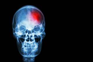 The combination of radiotherapy and immunotherapy for brain metastases is promising, though toxicity and timing are poorly-understood factors. The combination of radiotherapy and immunotherapy for brain metastases is promising, though toxicity and timing are poorly-understood factors.