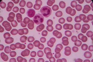 In order to optimize therapeutic sequencing among patients with CLL, 5 patient aspects must be considered. In order to optimize therapeutic sequencing among patients with CLL, 5 patient aspects must be considered.