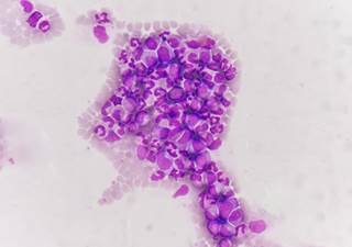 Among patients with R/R disease, 19.3% achieved complete remission (CR) and had a median overall survival of 19.7 months. Among patients with R/R disease, 19.3% achieved complete remission (CR) and had a median overall survival of 19.7 months.
