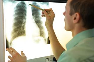 Vemurafenib improves outcomes among patients with non–small cell lung cancer with a BRAFV600 mutation. Vemurafenib improves outcomes among patients with non–small cell lung cancer with a BRAFV600 mutation.