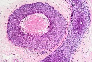 Participants in the low-dose tamoxifen arm experienced a 52% reduction in the cumulative risk of developing a recurrence, compared with placebo, researchers found. Participants in the low-dose tamoxifen arm experienced a 52% reduction in the cumulative risk of developing a recurrence, compared with placebo, researchers found.