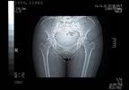Use of Aromatase Inhibitors in Advanced Endometrial Cancer Use of Aromatase Inhibitors in Advanced Endometrial Cancer