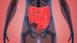 Patients had similar HRQOL scores by all measures at baseline, but experienced significant changes in scores for the HRQOL domains of Body Image, Diarrhea, Nutrition, Pain, and Role Function. Patients had similar HRQOL scores by all measures at baseline, but experienced significant changes in scores for the HRQOL domains of Body Image, Diarrhea, Nutrition, Pain, and Role Function.