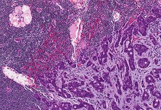 Women younger than 35 with HR-positive breast cancer can see significant improvements in BCFI when receiving tamoxifen and exemestane with OFS vs tamoxifen alone. Women younger than 35 with HR-positive breast cancer can see significant improvements in BCFI when receiving tamoxifen and exemestane with OFS vs tamoxifen alone.