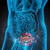 Overactive Bladder Linked to Prostate Cancer ADT Overactive Bladder Linked to Prostate Cancer ADT