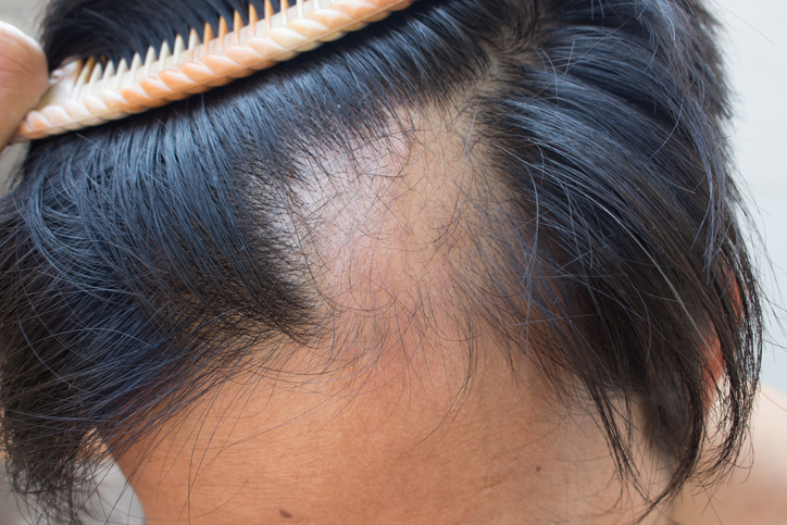 Scalp Cooling for Alopecia Among Patients With Breast Cancer - Cancer