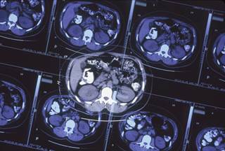 TTFs can be self-administered at home by patients; this novel radiation treatment is non-ionizing and delivers electrical fields directly to the brain. TTFs can be self-administered at home by patients; this novel radiation treatment is non-ionizing and delivers electrical fields directly to the brain.