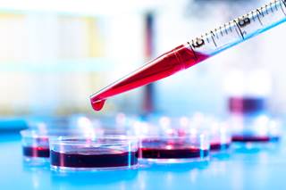 A number of studies have attempted to determine whether multiple myeloma is directly linked to autoimmune disease. A number of studies have attempted to determine whether multiple myeloma is directly linked to autoimmune disease.