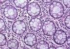 Effect of Neuroendocrine Tumor Classification Updates on Survival Rates in Pancreatic Cancer Effect of Neuroendocrine Tumor Classification Updates on Survival Rates in Pancreatic Cancer