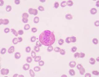 The phase 3 REMARC study enrolled 650 treatment-naive patients with DLBCL or other aggressive B cell lymphomas. The phase 3 REMARC study enrolled 650 treatment-naive patients with DLBCL or other aggressive B cell lymphomas.