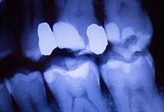 More studies are needed to determine the association between periodontal disease and non-Hodgkin lymphoma. More studies are needed to determine the association between periodontal disease and non-Hodgkin lymphoma.