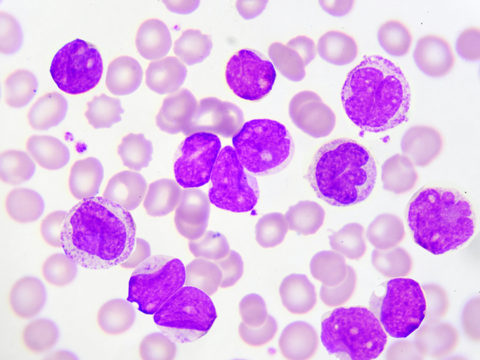 Atypical Chronic Myeloid Leukemia Current Research and 