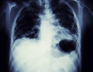 NLR can be used to predict overall survival in patients with locally advanced, non-small cell lung cancer. NLR can be used to predict overall survival in patients with locally advanced, non-small cell lung cancer.