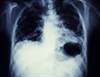 Predicting Overall Survival With Neutrophil-Lymphocyte Ratio in NSCLC Predicting Overall Survival With Neutrophil-Lymphocyte Ratio in NSCLC