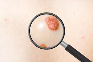 Patients with advanced melanoma may have good outcomes when treated with standard-dose pembrolizumab with 4 doses of reduced-dose ipilimumab. Patients with advanced melanoma may have good outcomes when treated with standard-dose pembrolizumab with 4 doses of reduced-dose ipilimumab.