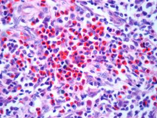 The U.S. Food and Drug Administration has approved brentuximab vedotin for the treatment of adult patients with pcALCL or CD30-expressing mycosis fungoides who have received prior systemic therapy. The U.S. Food and Drug Administration has approved brentuximab vedotin for the treatment of adult patients with pcALCL or CD30-expressing mycosis fungoides who have received prior systemic therapy.