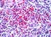 Lymphoma in Patients With Systemic Lupus Erythematosus: Expert Insights Lymphoma in Patients With Systemic Lupus Erythematosus: Expert Insights