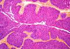 Pembrolizumab Shows Promise for BCG-Unresponsive Bladder Cancer Pembrolizumab Shows Promise for BCG-Unresponsive Bladder Cancer