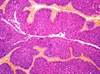 Pembrolizumab Shows Promise for BCG-Unresponsive Bladder Cancer Pembrolizumab Shows Promise for BCG-Unresponsive Bladder Cancer
